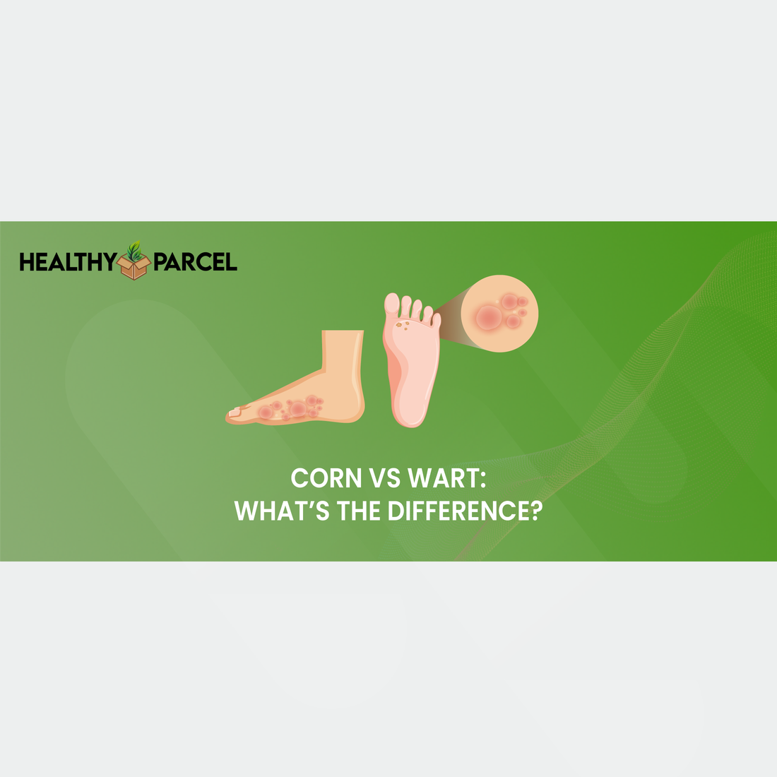 Corn vs Wart: What’s the Difference?